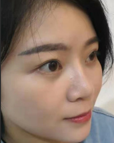 去眼袋手术