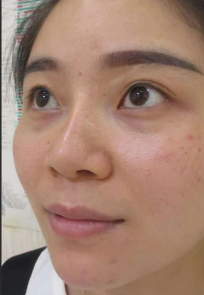 去眼袋手术
