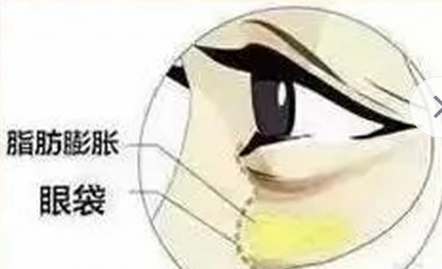 去眼袋手术