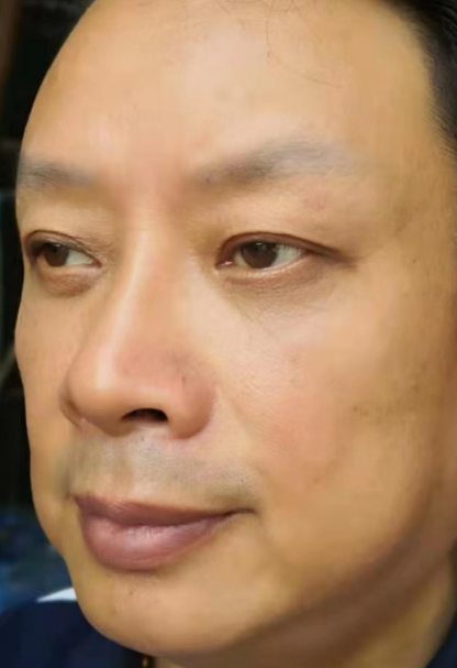 去眼袋手术