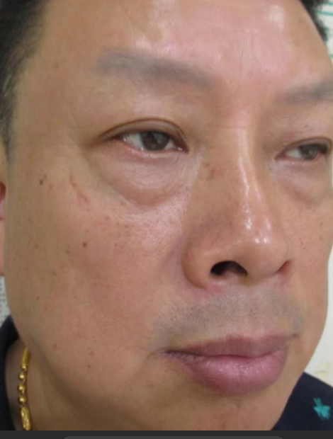 去眼袋手术