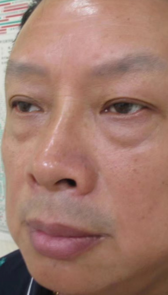 去眼袋手术