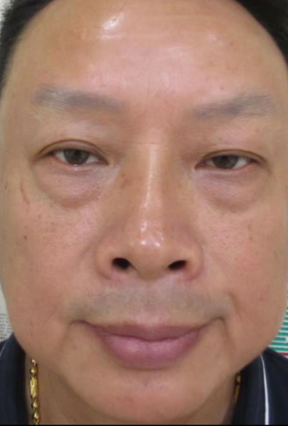 去眼袋手术