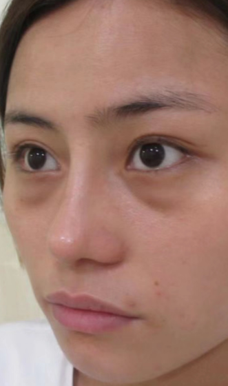 去眼袋手术
