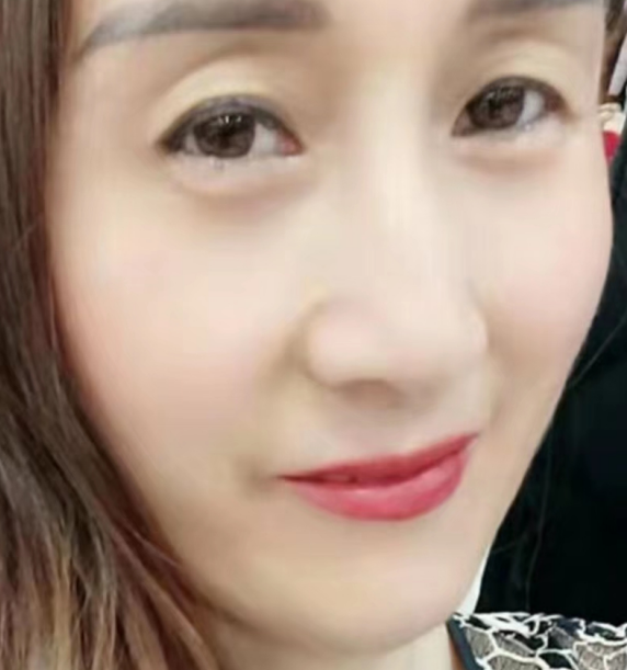 去眼袋手术