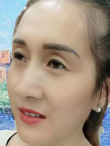 去眼袋手术