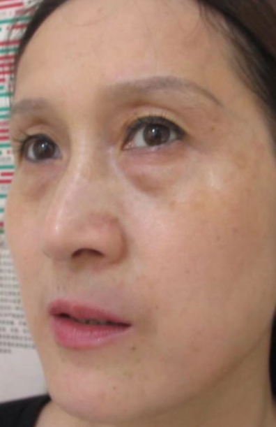 去眼袋手术