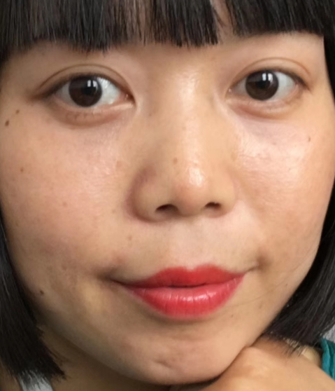 去眼袋手术