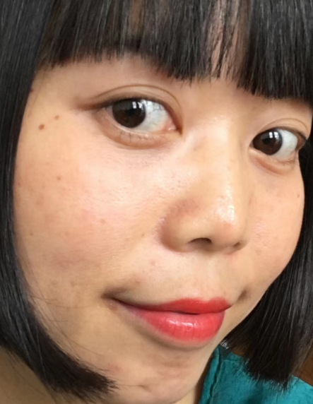 去眼袋手术