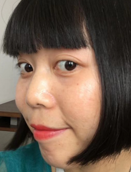 去眼袋手术