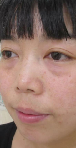 去眼袋手术