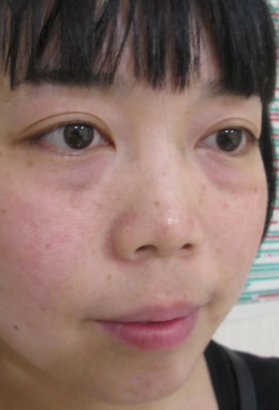 去眼袋手术