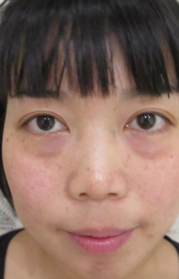 去眼袋手术