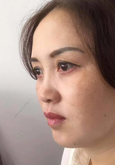 去眼袋手术