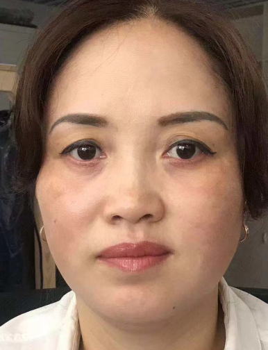 去眼袋手术