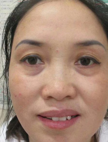 去眼袋手术