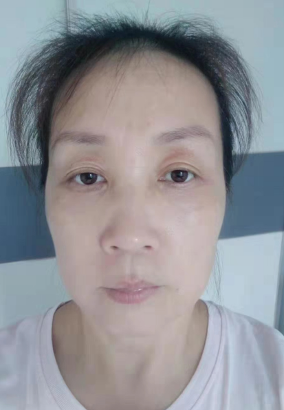 去眼袋手术