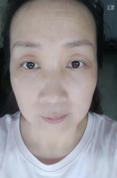 去眼袋手术