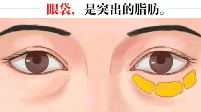 去眼袋手术
