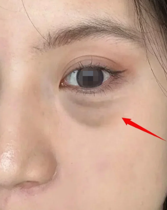 去眼袋手术