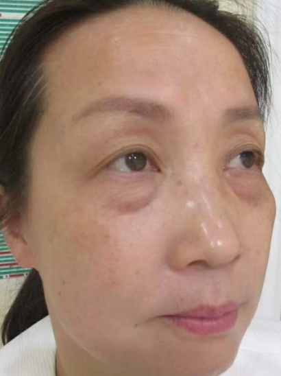 去眼袋手术