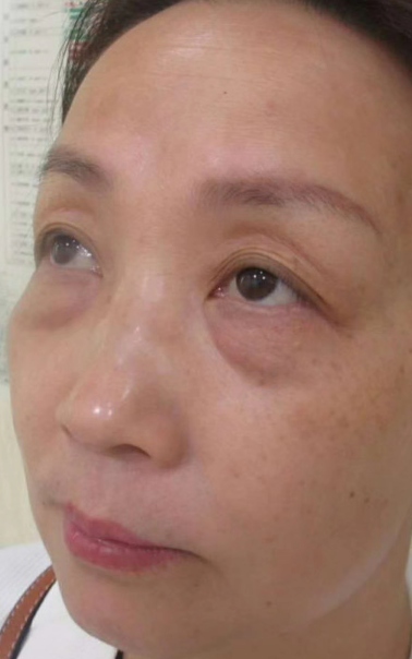 去眼袋手术