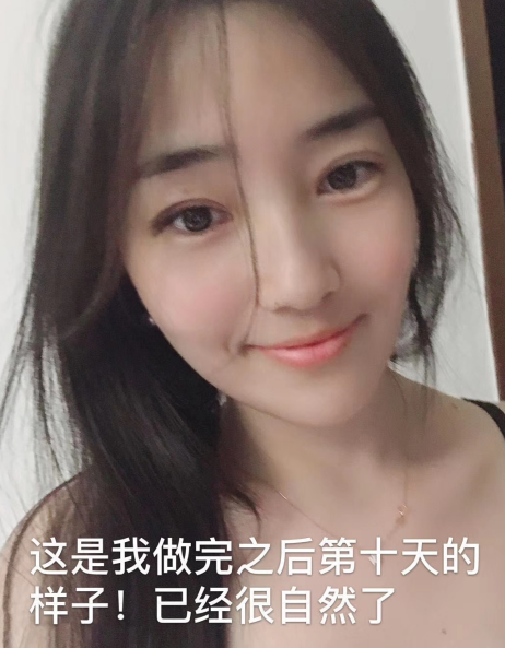 去眼袋手术