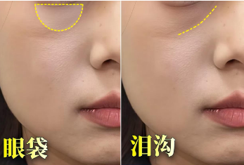 去眼袋手术