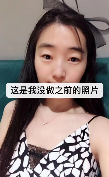去眼袋手术