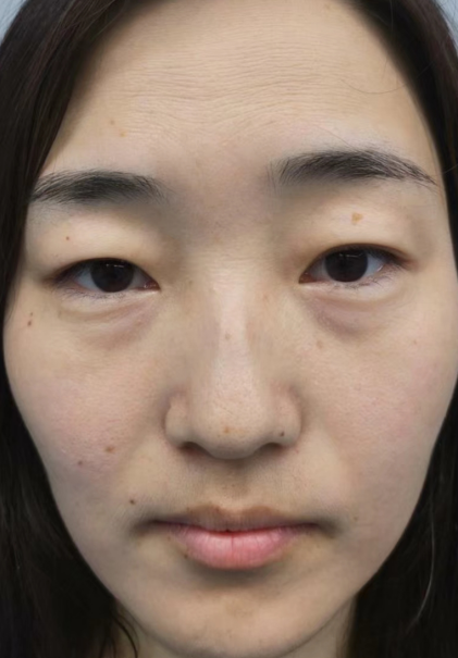 去眼袋手术
