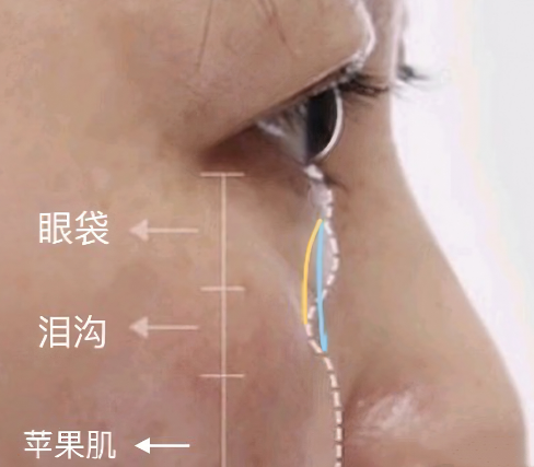 去眼袋手术