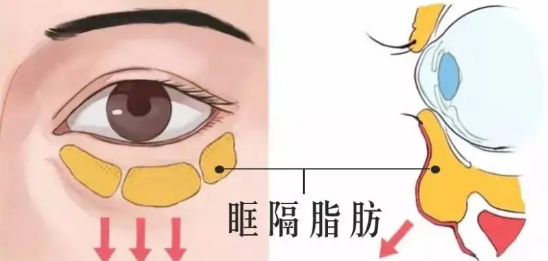去眼袋手术