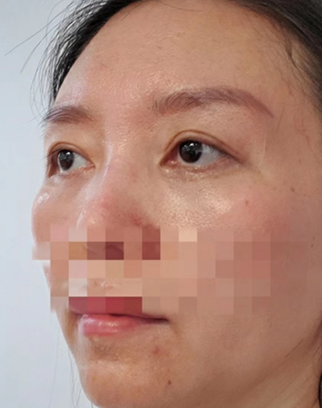 去眼袋手术