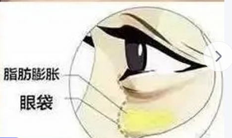 去眼袋手术