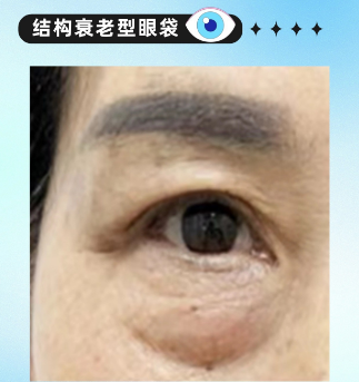 去眼袋手术