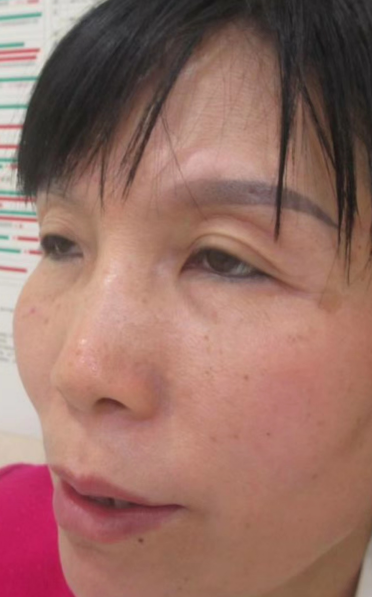 去眼袋手术