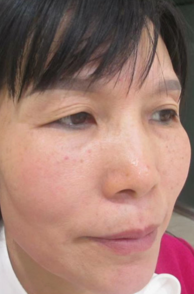 去眼袋手术