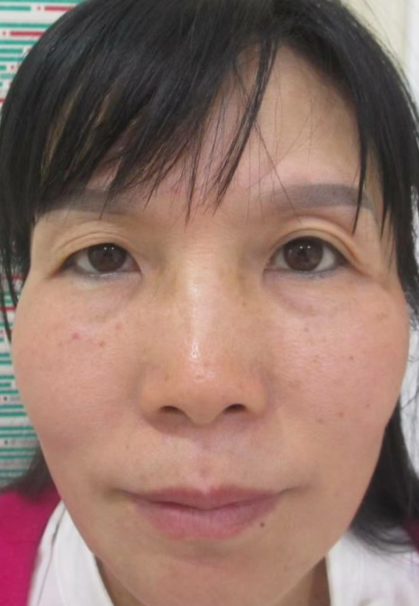 去眼袋手术