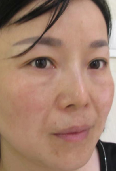 去眼袋手术