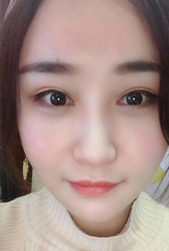 去眼袋手术