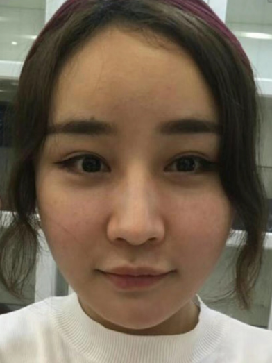 去眼袋手术