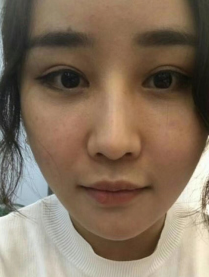去眼袋手术