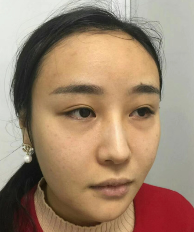 去眼袋手术