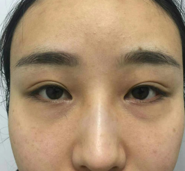 去眼袋手术