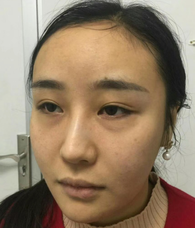 去眼袋手术