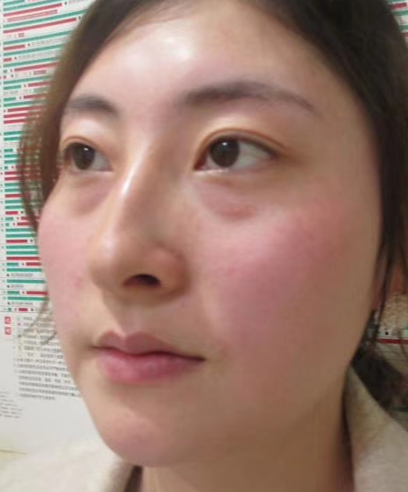 去眼袋手术