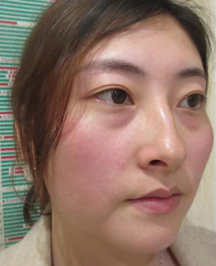 去眼袋手术