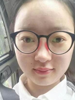 去眼袋手术