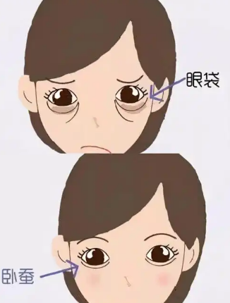 去眼袋手术