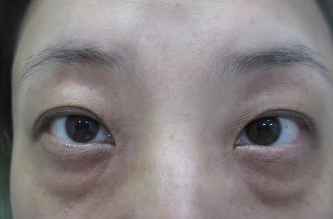 去眼袋手术